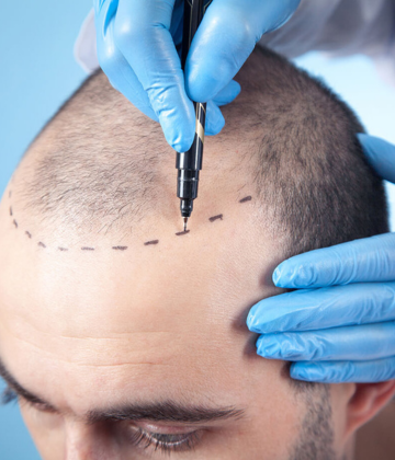 The Ultimate Guide to Hair Transplantation