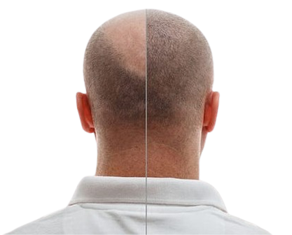 Percutaneous Hair Transplant